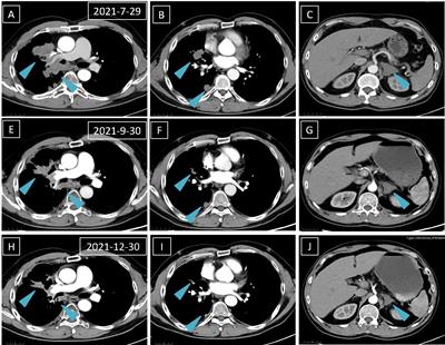 Rapid response to monotherapy with MEK inhibitor trametinib for a lung adenocarcinoma patient harboring primary SDN1-BRAF fusion: A case report and literature review